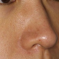 Skin Imperfections project thumbnail
