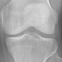 Leg Bone project thumbnail