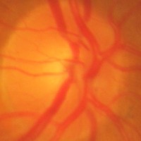 Glaucoma dataset project thumbnail