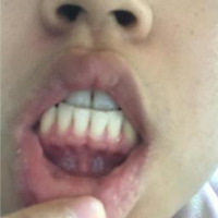teeth project thumbnail