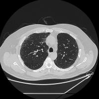 Chest CT Scan project thumbnail