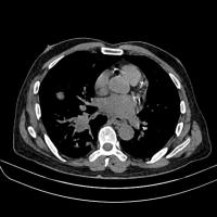 Multi Class Chest disease project thumbnail