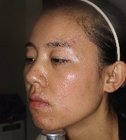 ACNE Detection Object Detection Model by BEAUTYAI