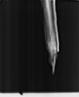 fracuted-bone project thumbnail