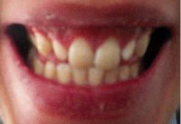 teethv2 project thumbnail