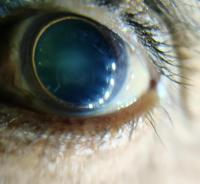 Cataract-Stage-Classification project thumbnail