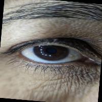Augmented-Cataract-Staging project thumbnail