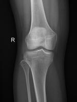 knees detection project thumbnail