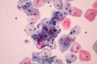 Cervical Carcinoma project thumbnail
