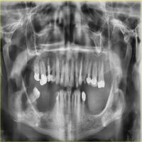 tooth filling detection project thumbnail