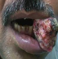 cancer project thumbnail