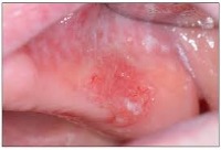 Oral Cancer project thumbnail
