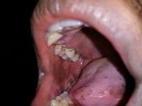 Oral cancer project thumbnail