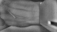 catheter needle segment project thumbnail