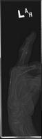 Bone Fracture Detection  project thumbnail