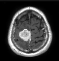 brain-tumor-segmentation project thumbnail