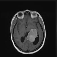 brain tumor segmentation project thumbnail