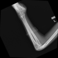 Joint Bone fracture shuffled project thumbnail