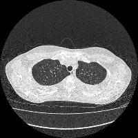 CT of the Chest project thumbnail