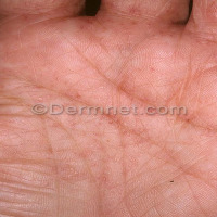 skin disease project thumbnail