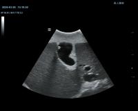 gallbladder_s01 project thumbnail
