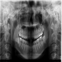 Dental X-Ray Panoramic Dataset project thumbnail