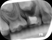 teeth detect project thumbnail