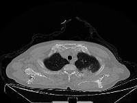 Lung Cancer Detection (Model) project thumbnail