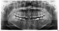 Periodontitis_Segmentation project thumbnail