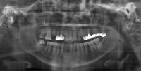 Caries Model 2 project thumbnail