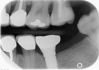 Tooth Caries Detection project thumbnail