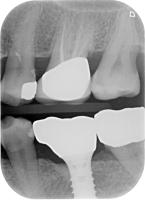 teeth project thumbnail