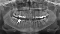tooth_detec project thumbnail