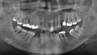 thirdmolar project thumbnail
