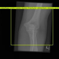 bone fracture prediction  project thumbnail
