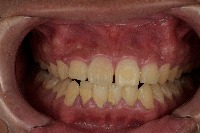 Gingivitis2 project thumbnail