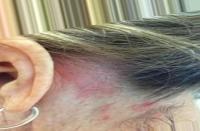 Hair and Scalp Diseases project thumbnail
