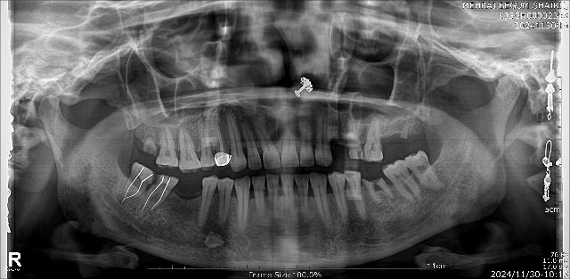opgfree Object Detection Model by Oral lesion detection