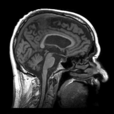 Brain Cancer Detection - Mri Images Classification Dataset And Pre 