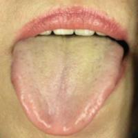 TongueDiagnosis project thumbnail
