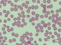 Malaria project thumbnail
