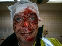 Injuries-Blood project thumbnail