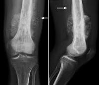 Bone Cancer Detection project thumbnail