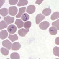 malaria project thumbnail