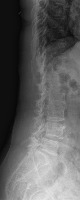 Spondylolisthesis project thumbnail