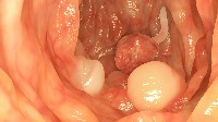 Polyp Detection project thumbnail