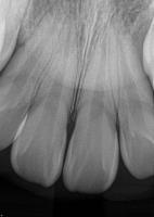 V_2_tooth_number_6_to_11 project thumbnail