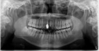 kaggle periepical project thumbnail