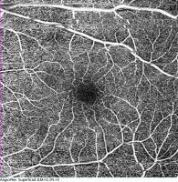 octa-vascular-density project thumbnail