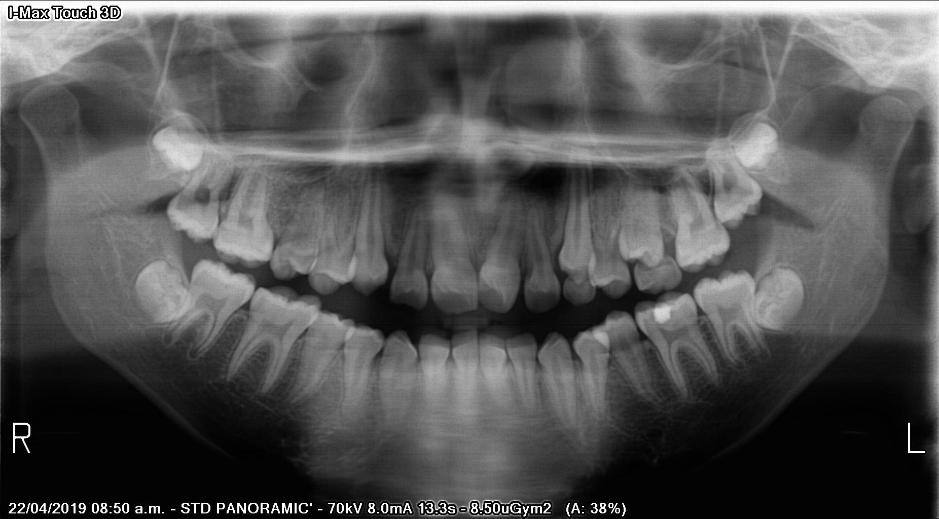 teeth detection and numbering Object Detection Model by Prime